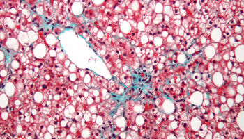 A step towards the first Canadian drug for fatty liver disease